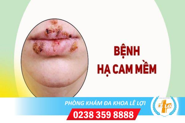 Chi phí khám hạ cam mềm hiện nay bao nhiêu?