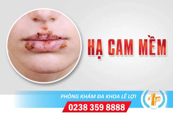 Địa chỉ khám hạ cam mềm uy tín hiện nay