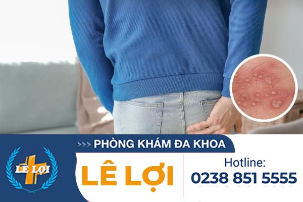 Biểu hiện bệnh herpes hậu môn và cách điều trị