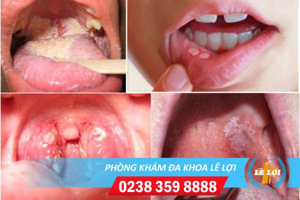 Cách chữa lậu ở miệng hiệu quả