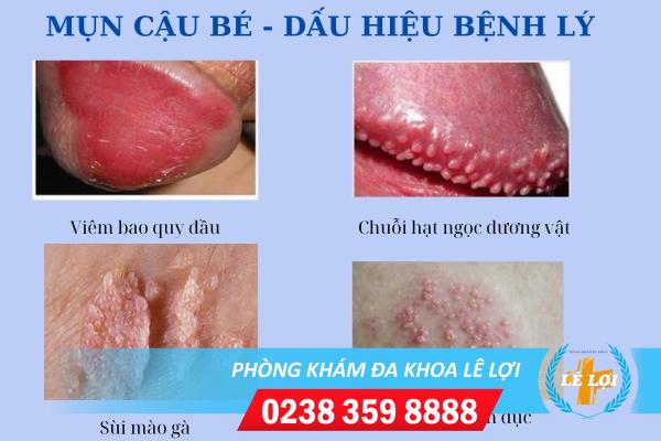 mun-cau-be