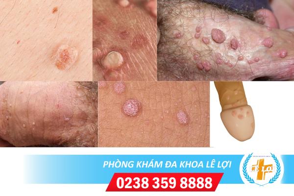Cách trị mụn cơm sinh dục hiệu quả cao