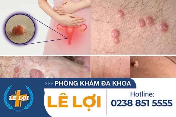 Cách điều trị mụn cóc sinh dục