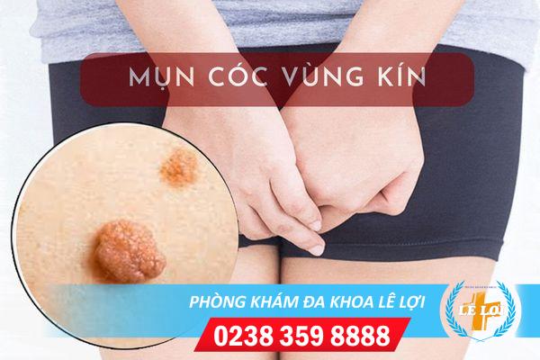 Nổi mụn cóc vùng kín có sao không?