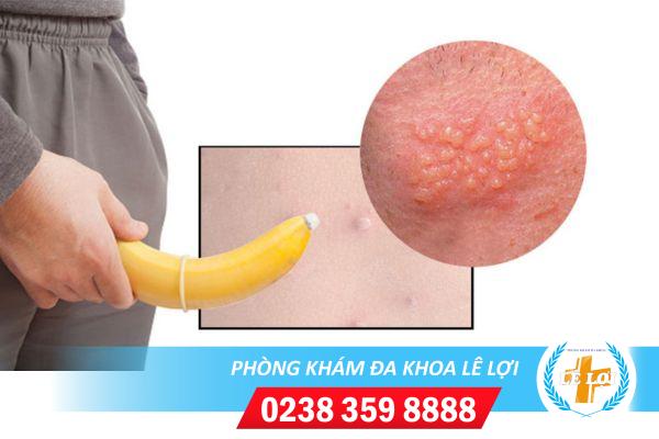Mụn li ti dương vật: Dấu hiệu bệnh đáng lo