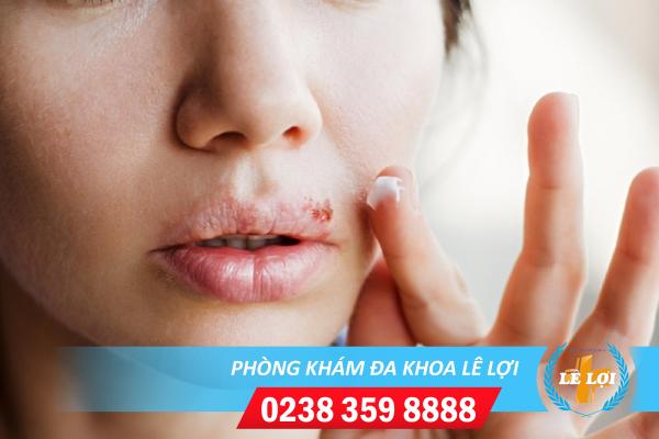 Chi phí khám chữa sùi mào gà miệng hiện nay