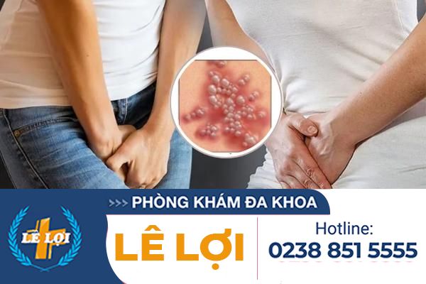 Địa chỉ khám chữa mụn rộp sinh dục uy tín ở Vinh