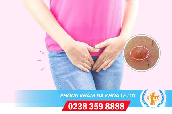 Mụn thịt âm đạo là bị gì? điều trị thế nào?