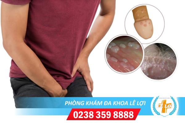Mụn trắng nhỏ ở dương vật nguy hiểm không?