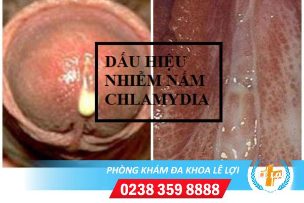 Cách điều trị bệnh Chlamydia hiệu quả nhanh hiện nay