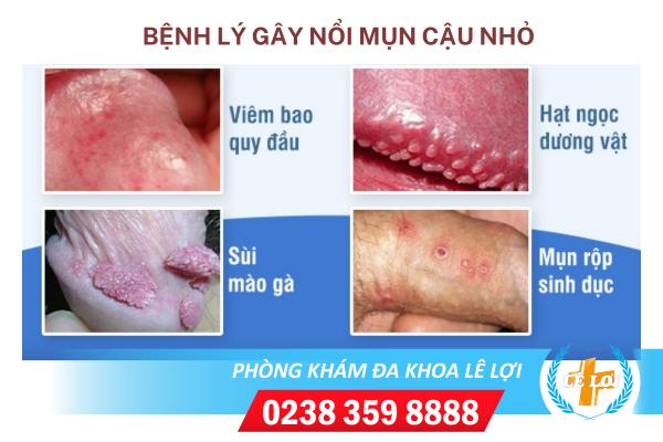 nguyen-nhan-noi-mun-cau-nho