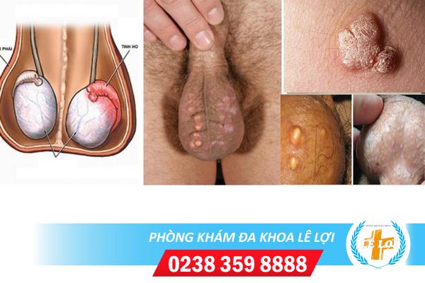 Nguyên nhân nổi mụn ở bìu và cách điều trị