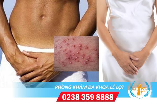 Nguyên nhân và cách điều trị nổi mụn sinh dục