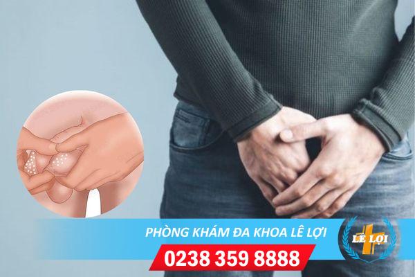 Nổi mụn trắng ở dương vật có sao không?