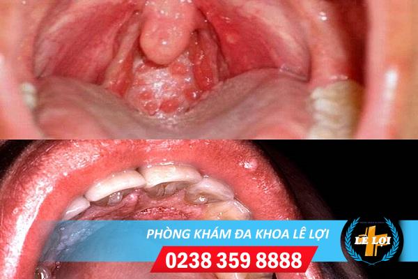 Cách nhận biết sùi mào gà ở họng, đi điều trị sớm