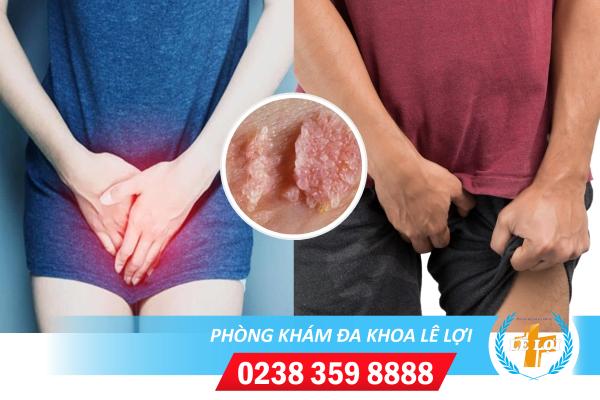 Triệu chứng bệnh sùi mào gà bộ phận sinh dục