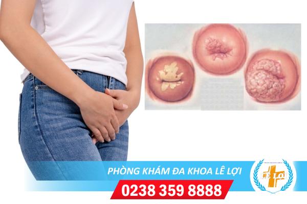 Sùi mào gà cổ tử cung phải làm sao?