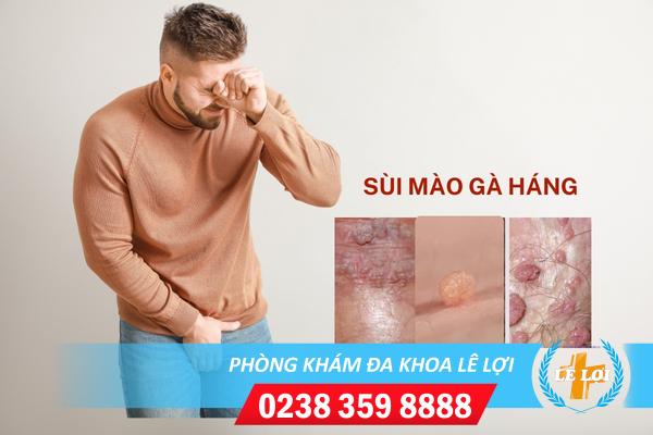 Sùi mào gà háng triệu chứng nhận biết và cách điều trị