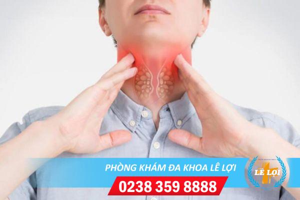 Biểu hiện sùi mào gà họng dễ nhận biết