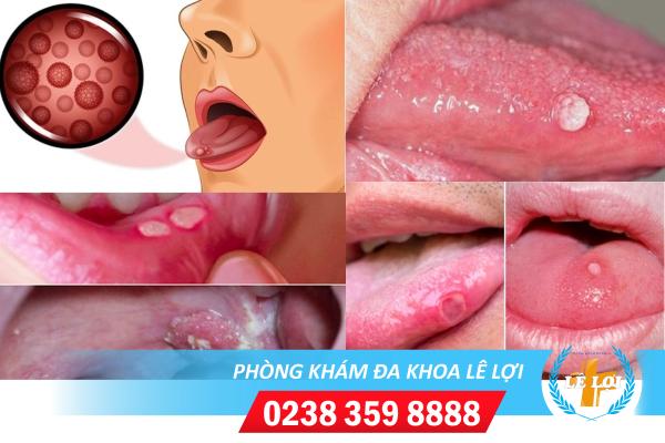 Dấu hiệu sùi mào gà lưỡi giai đoạn đầu
