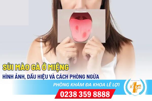Dấu hiệu sùi mào gà ở miệng bạn cần biết sớm