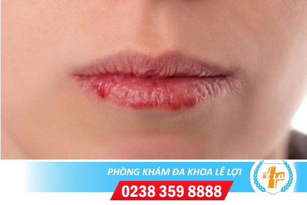 Hình ảnh sùi mào gà ở miệng