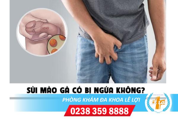 Sùi mào gà có ngứa không?