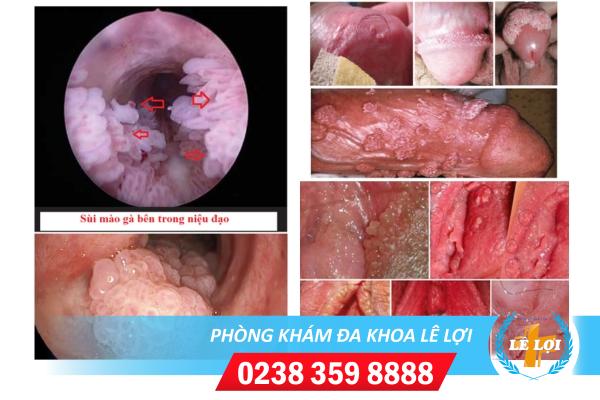 Dấu hiệu nhận biết bệnh sùi mào gà lỗ sáo