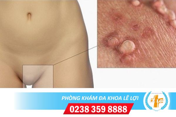 Cách trị sùi mào gà ở bẹn nhanh hết