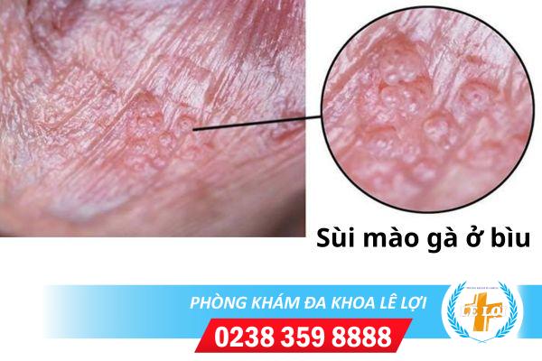 Triệu chứng sùi mào gà ở bìu dễ nhận biết