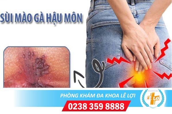 Dấu hiệu sùi mào gà hậu môn dễ dàng nhận ra