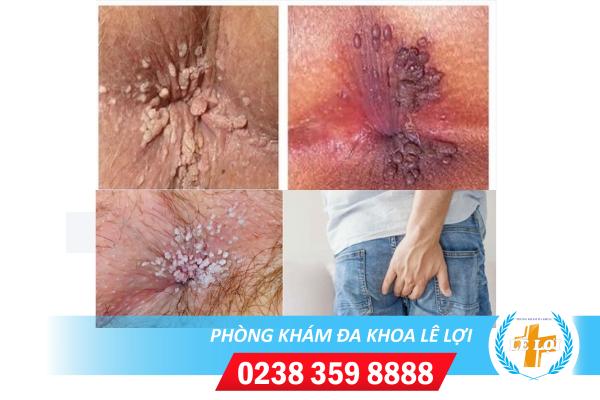 Dấu hiệu sùi mào gà hậu môn giai đoạn đầu