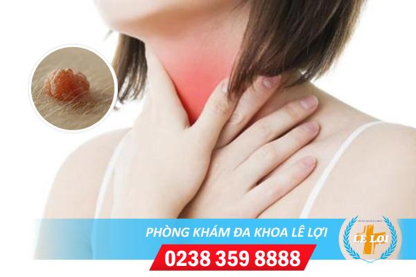 Nguyên nhân sùi mào gà ở họng và cách điều trị