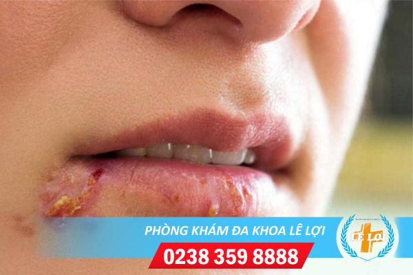 Dấu hiệu nhận biết sùi mào gà ở miệng, cần đi khám ngay