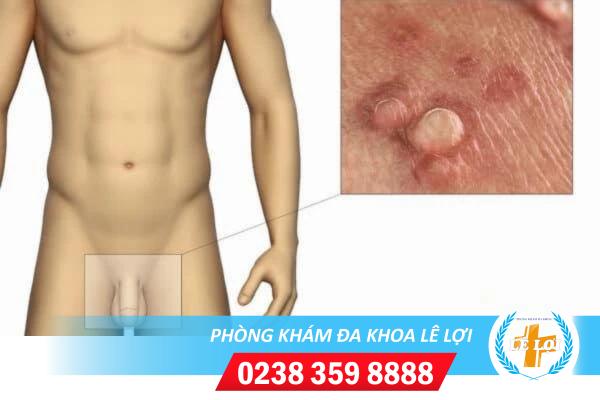 Địa chỉ chữa trị sùi mào gà quy đầu hiệu quả hiện nay