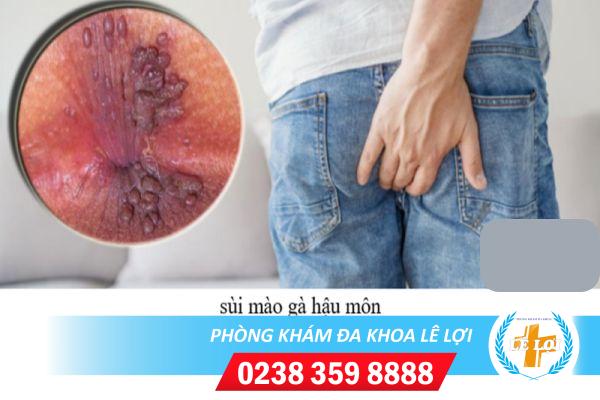 Cách chữa sùi mào gà ở hậu môn hiệu quả hiện nay