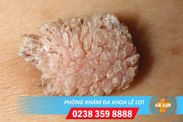 Bị súp lơ sùi mào gà khám chữa ở đâu nhanh khỏi?