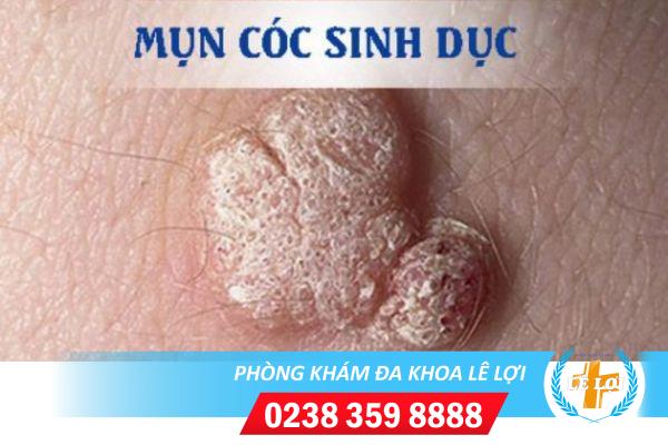 Lưu ý quan trọng khi dùng thuốc bôi mụn cóc sinh dục