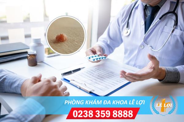 Cách trị mụn cóc ở dương vật hiệu quả