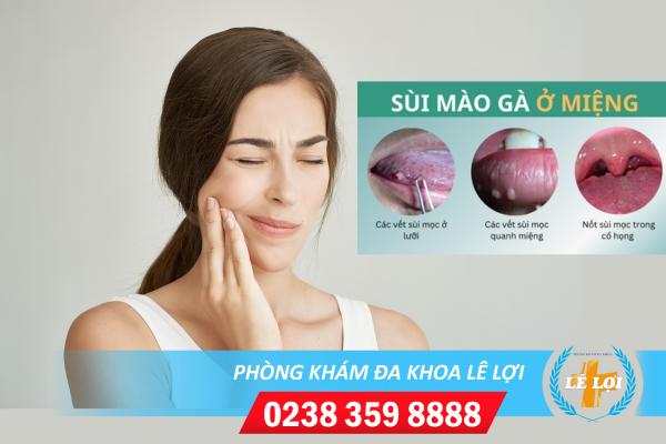 Triệu chứng sùi mào gà ở miệng