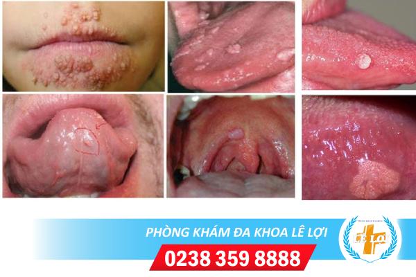 Sùi mào gà miệng có ngứa không?