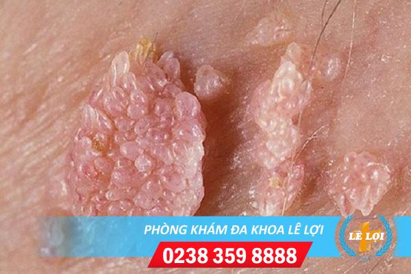 U nhú màu trắng đục là dấu hiệu bệnh gì?
