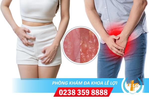 U nhú sinh dục và những tác hại nguy hiểm
