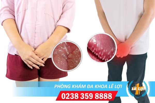 U nhú cơ quan sinh dục là gì nguy hiểm không?