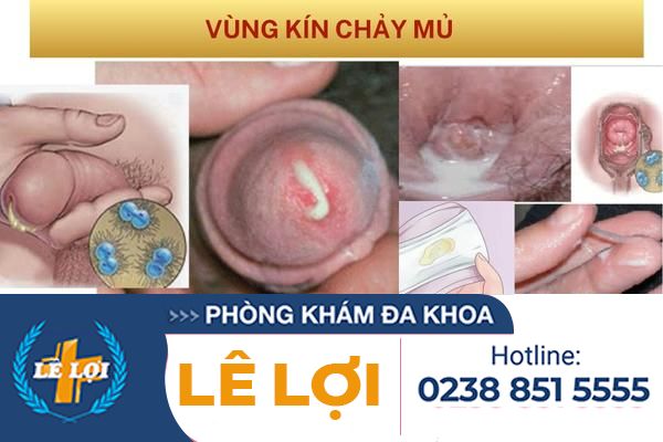 Vùng kín chảy mủ dấu hiệu cảnh báo nhiều bệnh lý