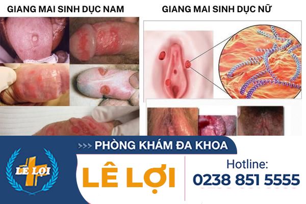 dau-hieu-giang-mai-sinh-duc
