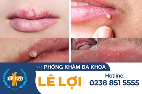 Nổi mụn trắng ở môi là bị bệnh gì?