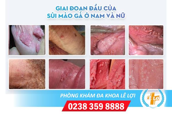 Địa chỉ bệnh viện khám chữa sùi mào gà uy tín hiện nay