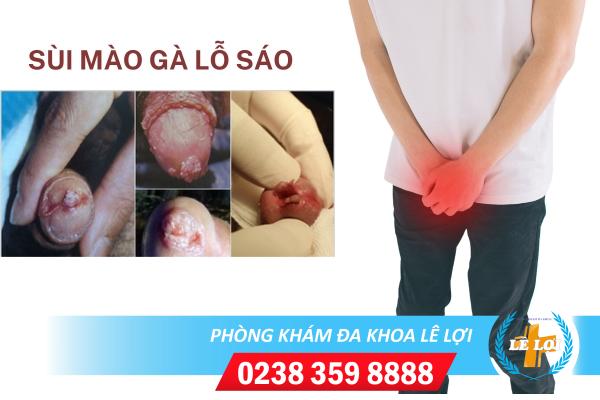 Dấu hiệu sùi mào gà lỗ sáo và cách điều trị