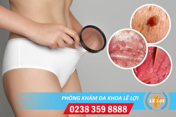 Cách chữa sùi mào gà vùng kín nữ